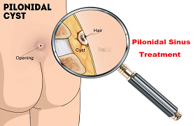 Pilonidal Cyst » Colorectal Clinic of Michigan